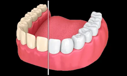 27298 teeth whitening costa rica vacation