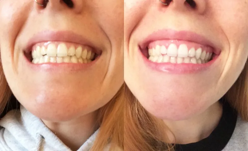 27299 black diamond whitening results
