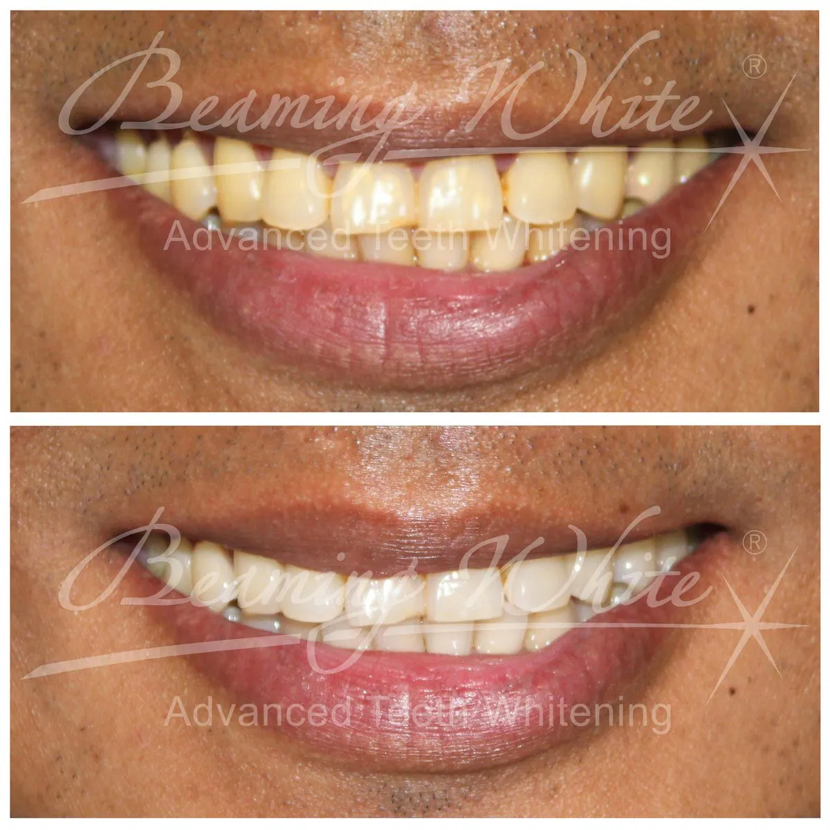 27299 hydrogen peroxide teeth whitening