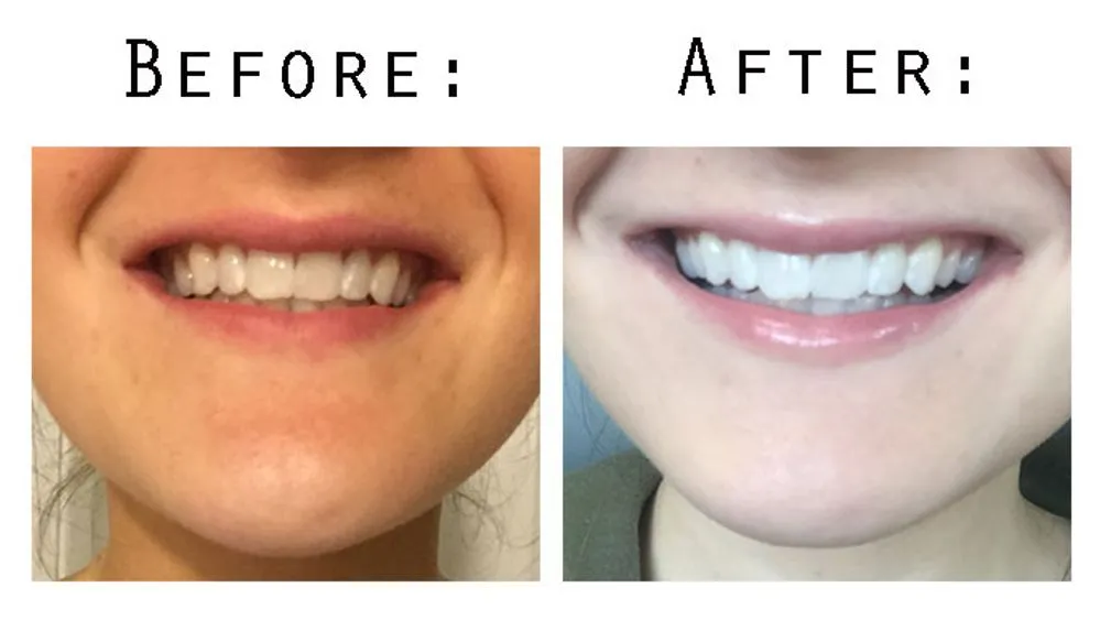 27299 teeth whitening comparison