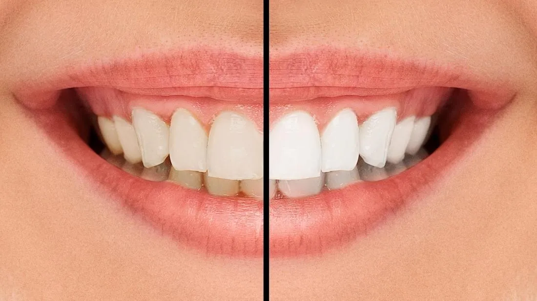 27304 teeth whitening methods