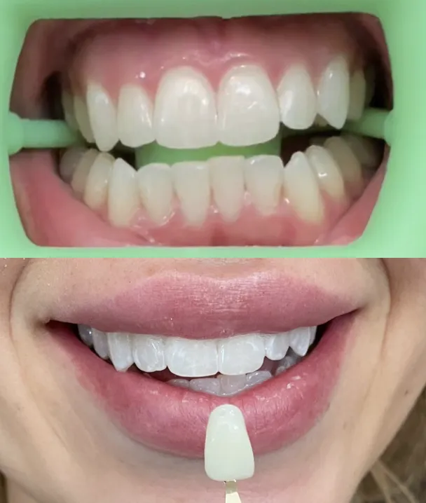27305 teeth whitening cost san antonio