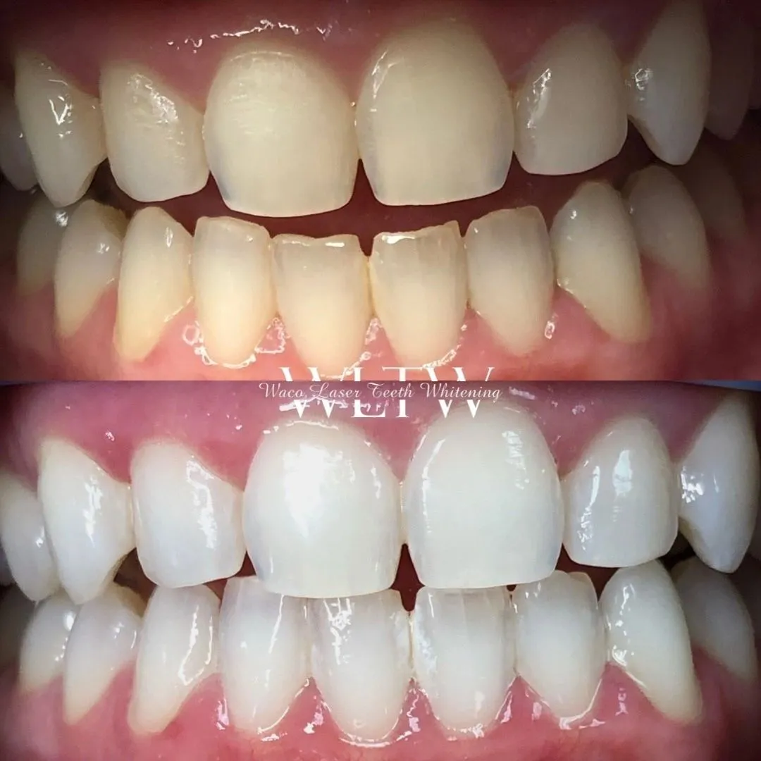 27307 waxahachie teeth whitening professional