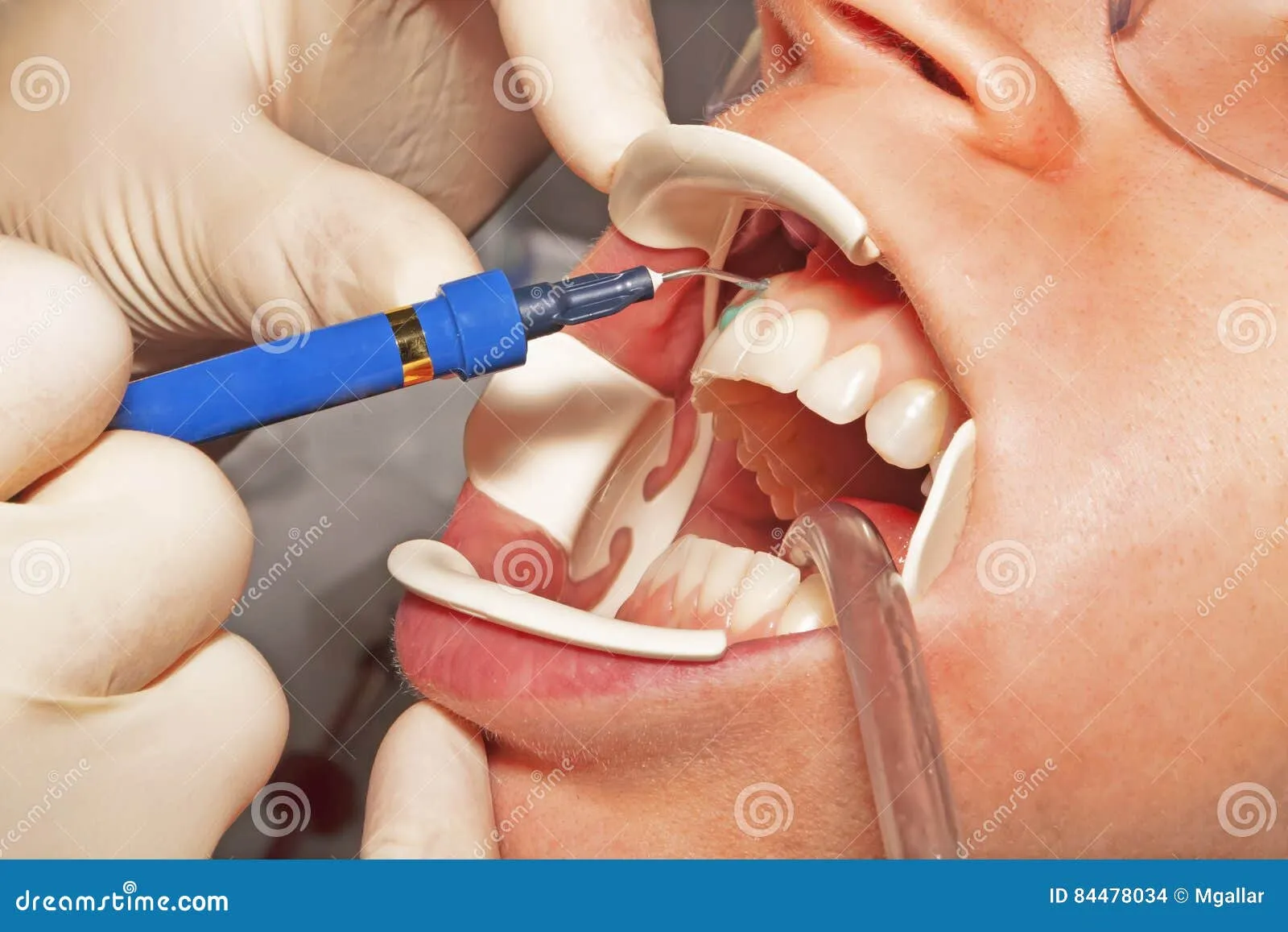 27318 dental hygiene cleaning