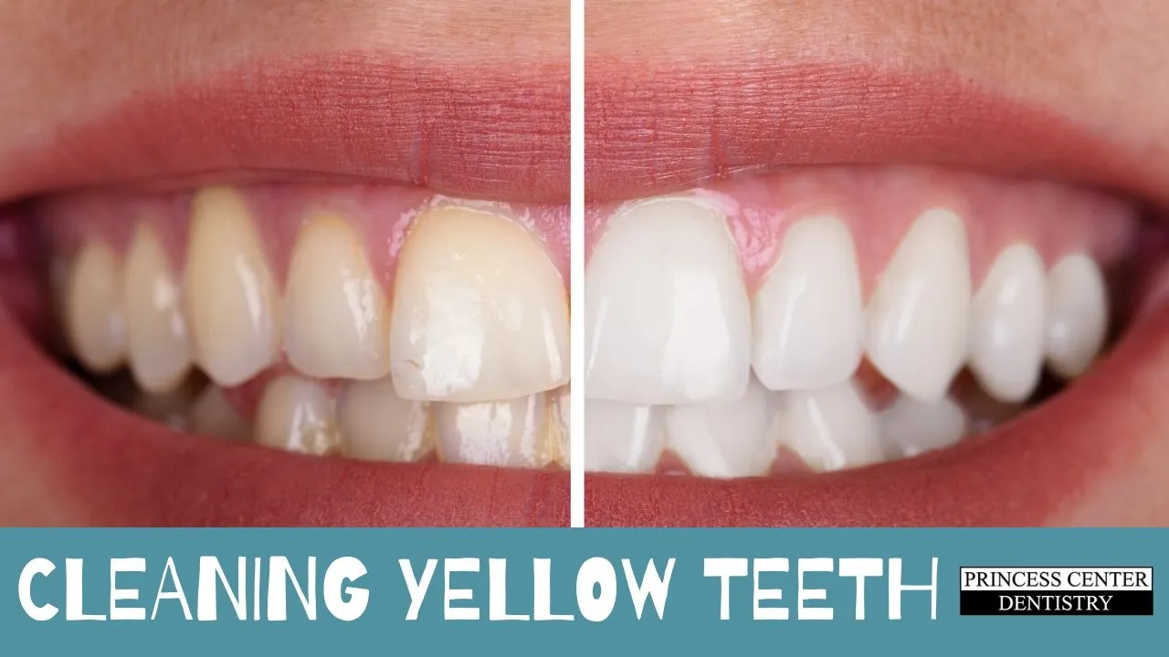 27318 teeth whitening results