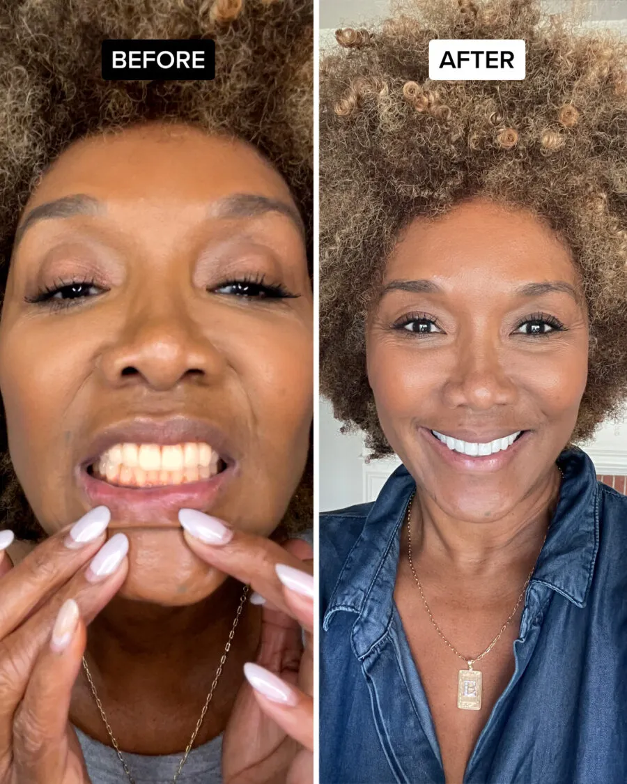 27323 influencer smile before after
