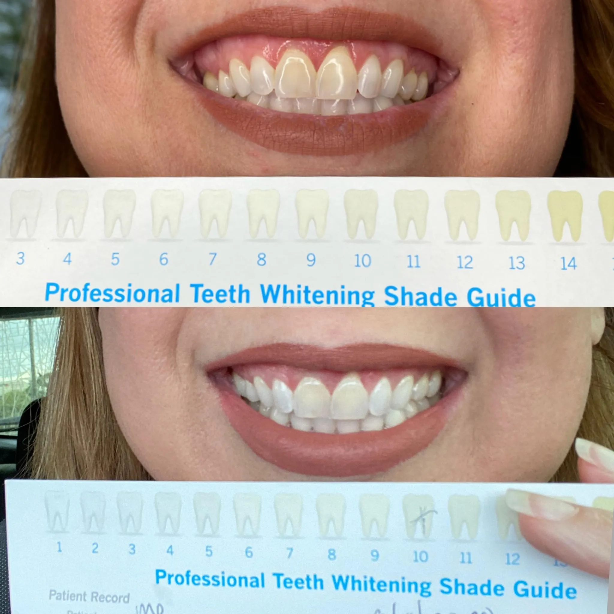 27327 teeth whitening cost