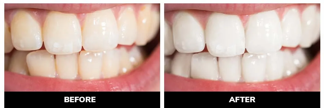 27329 teeth whitening colorado springs before after