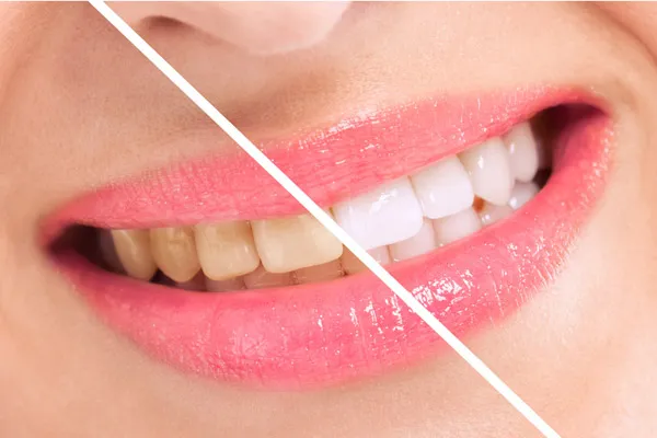 27329 teeth whitening colorado springs checkup
