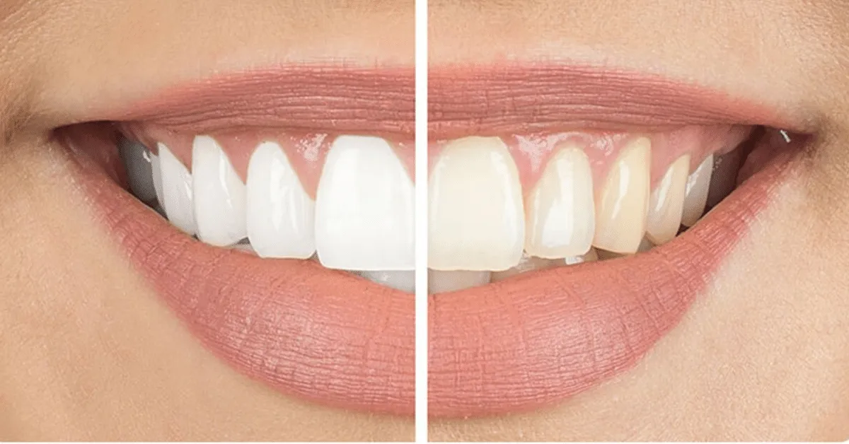 27335 teeth whitening options