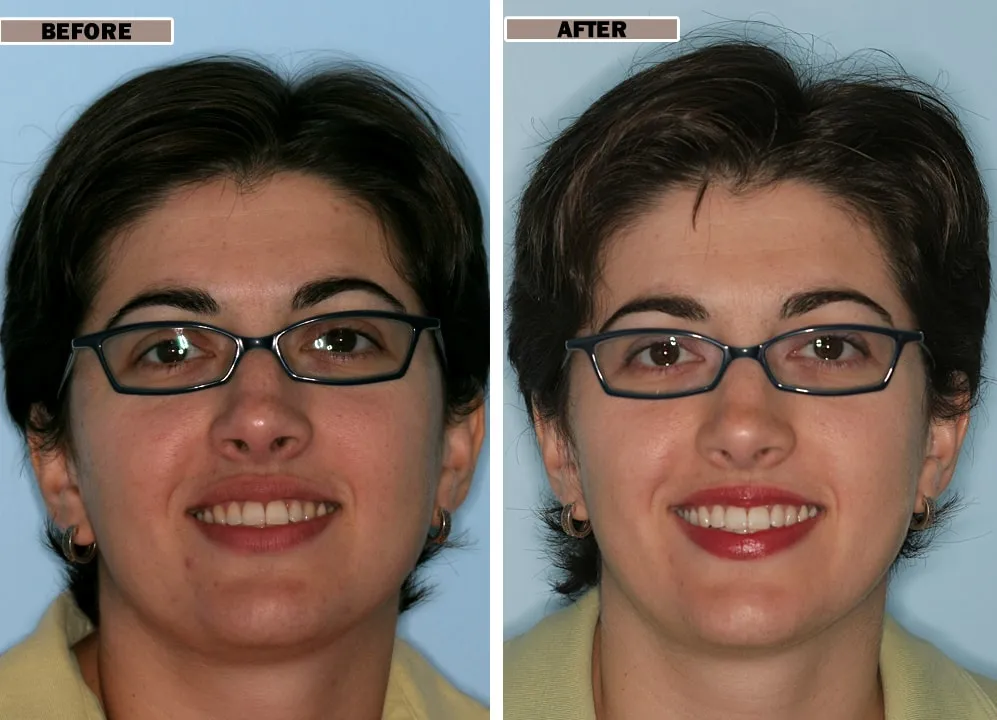 27336 teeth whitening aftercare