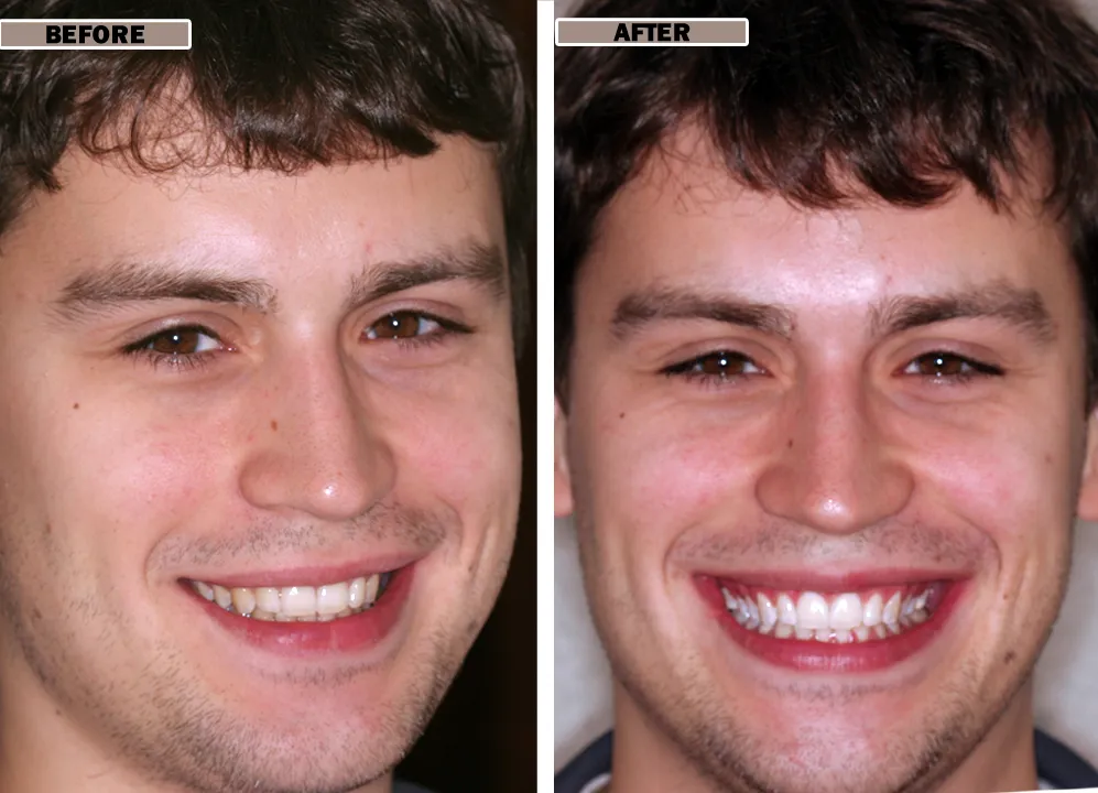 27336 teeth whitening cost