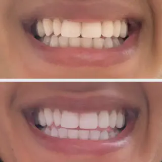 /img/27336-teeth-whitening-results.webp
