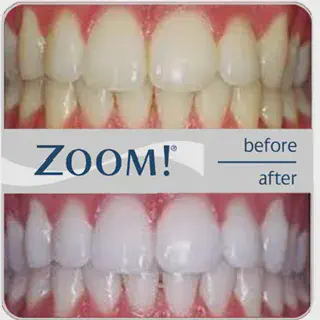 /img/27348-zoom-whitening-nyc-results.webp