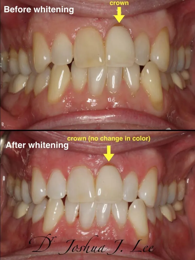 27348 zoom whitening patient smile