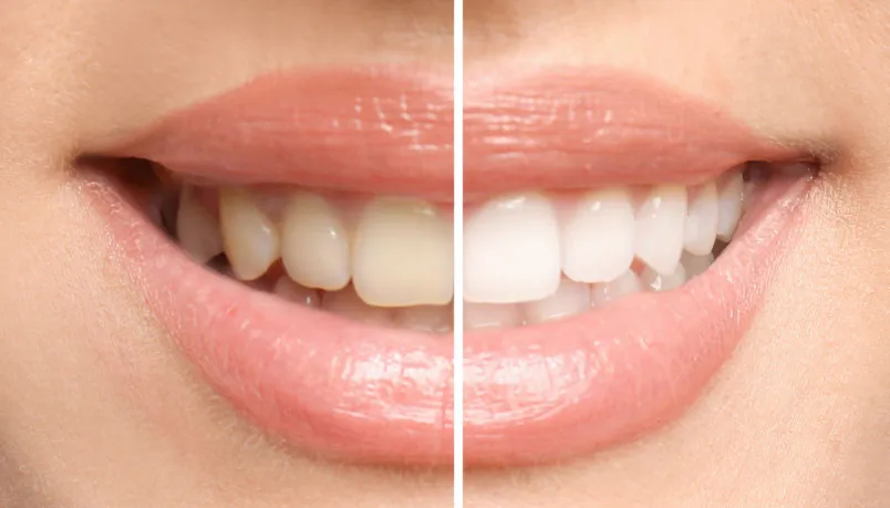 27354 idaho smiles teeth whitening results