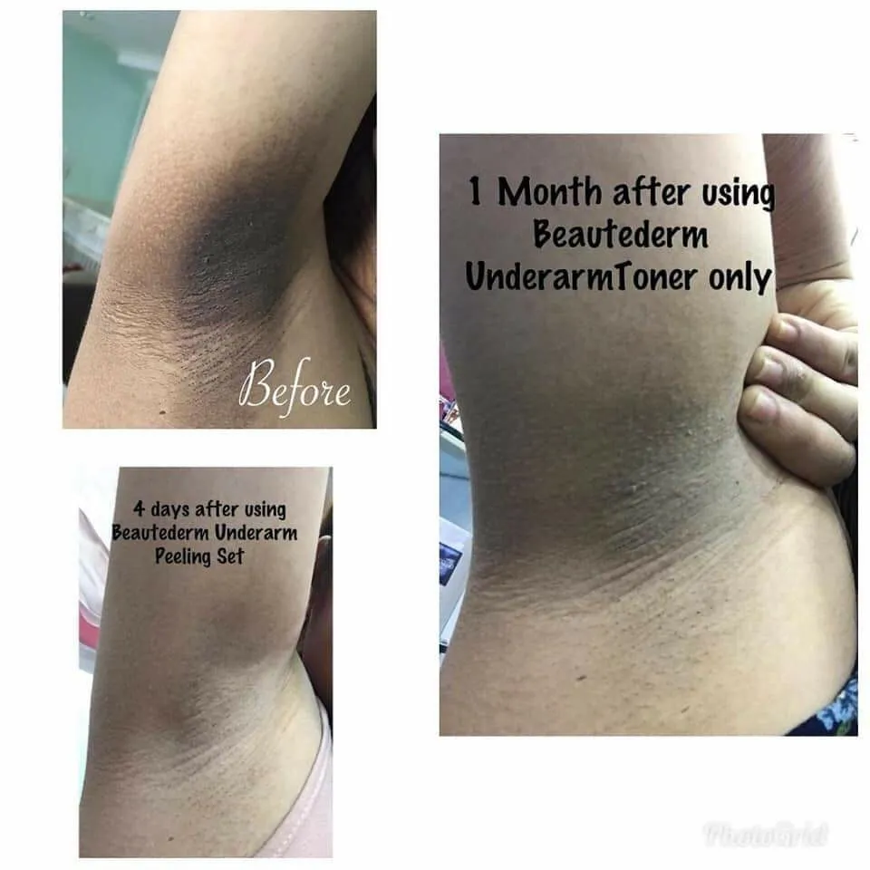 27356 underarm whitening creams