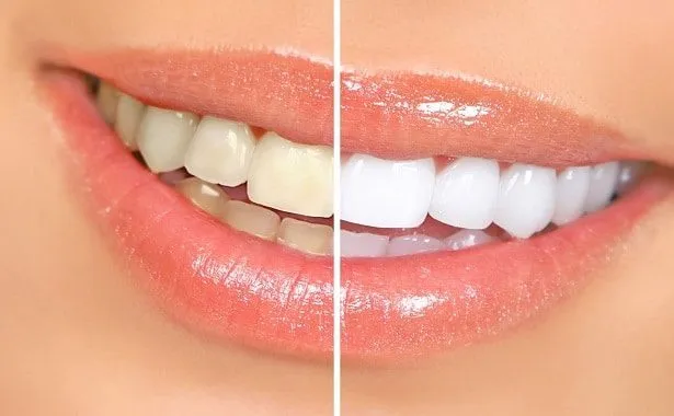 27361 nhs teeth whitening image3