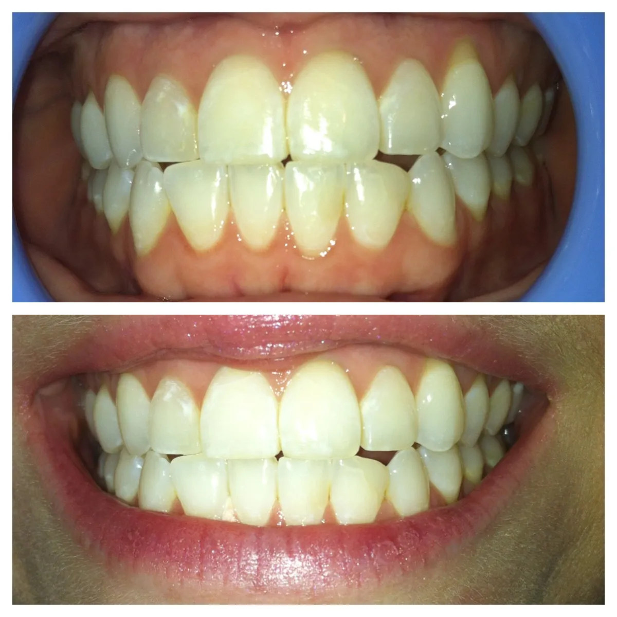 27373 laser teeth whitening image2