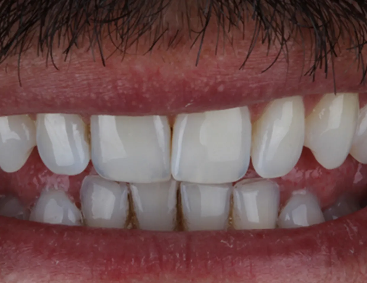 27373 laser teeth whitening image3