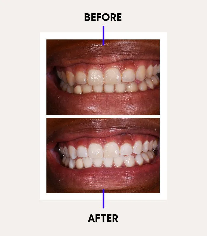 27373 laser teeth whitening image5