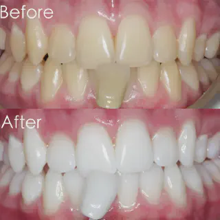/img/27373-laser-teeth-whitening-image7.webp