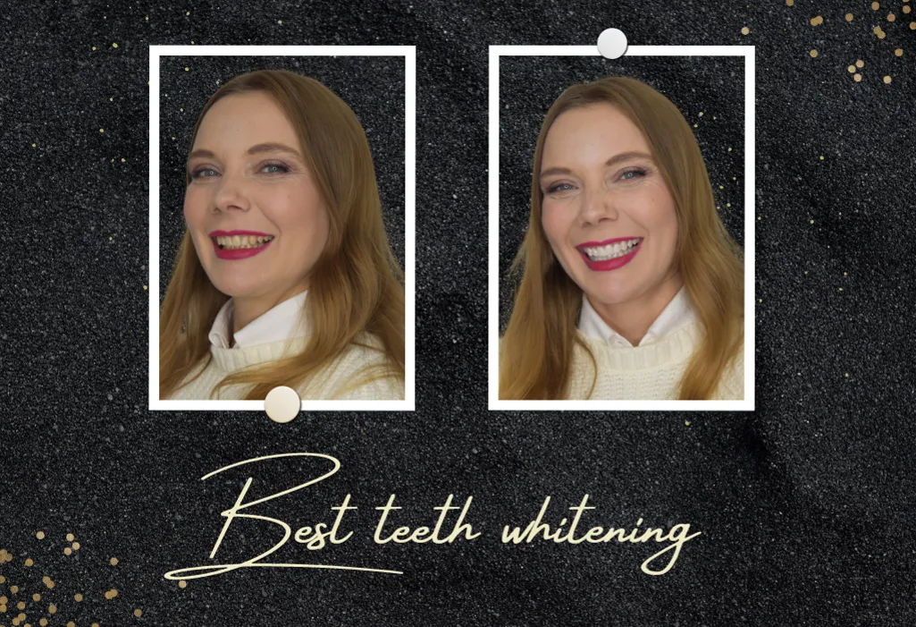 27383 professional teeth whitening