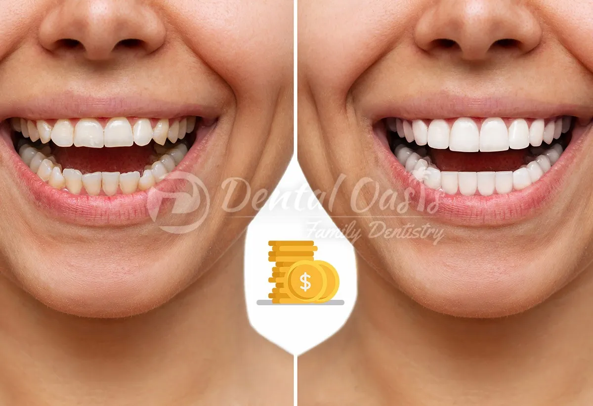 27387 dental whitening maintenance