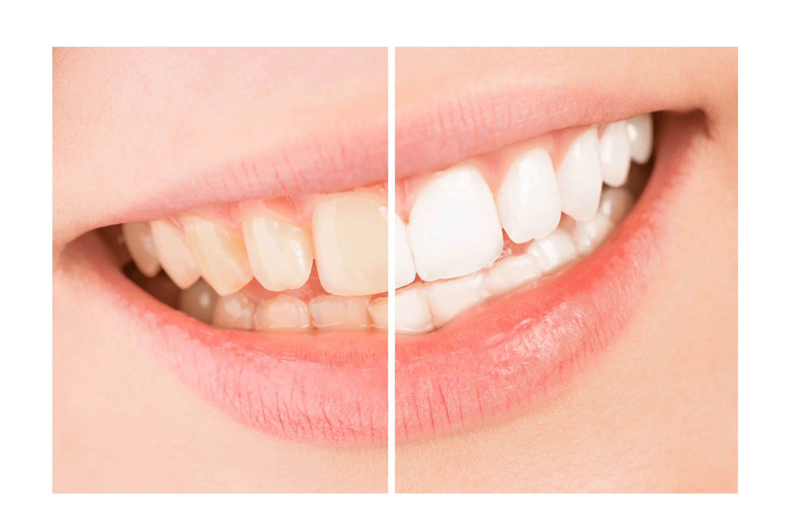 27392 professional teeth whitening