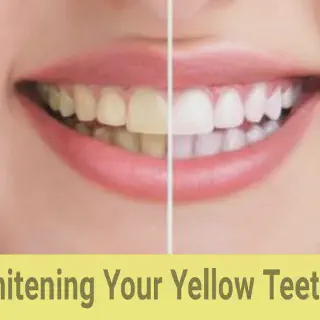/img/27392-teeth-whitening-results.webp