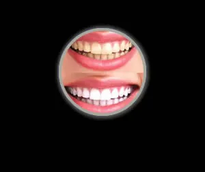 27397 teeth whitening results