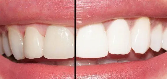 27399 teeth whitening methods