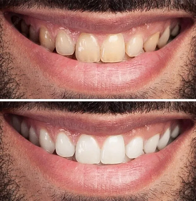 27402 at home teeth whitening