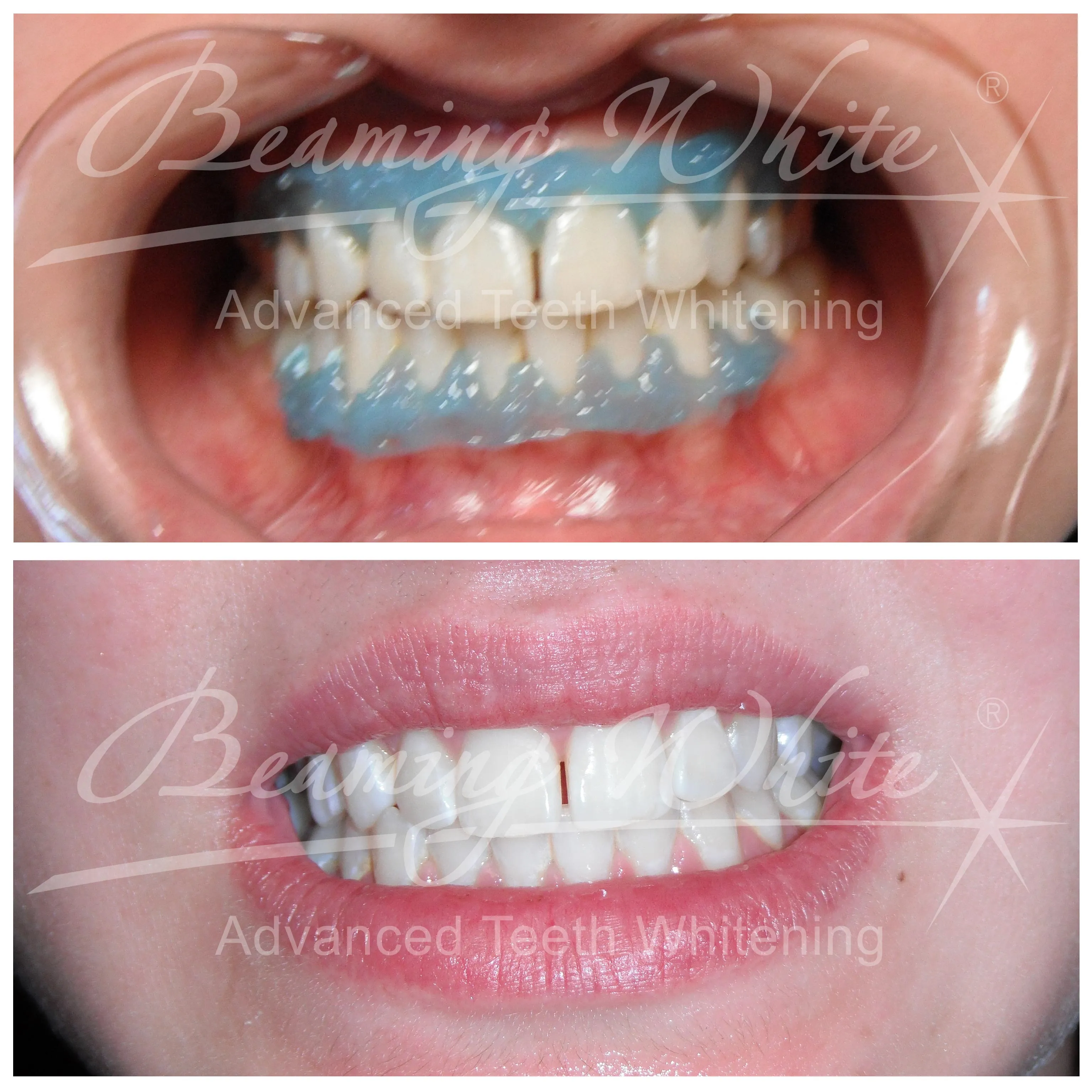 27402 teeth whitening process