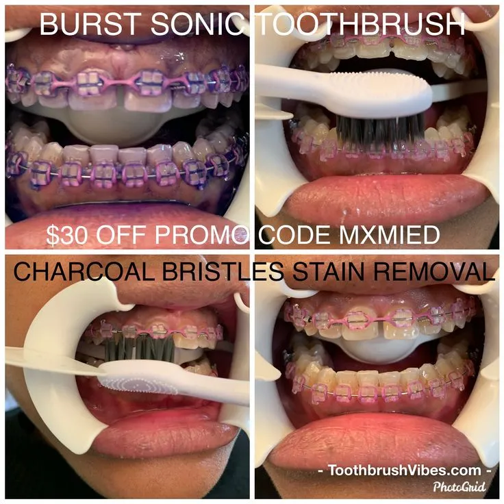 27413 whitening strips braces image5