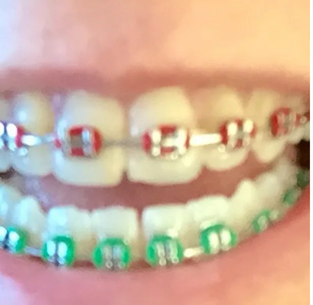 27413 whitening strips braces image7