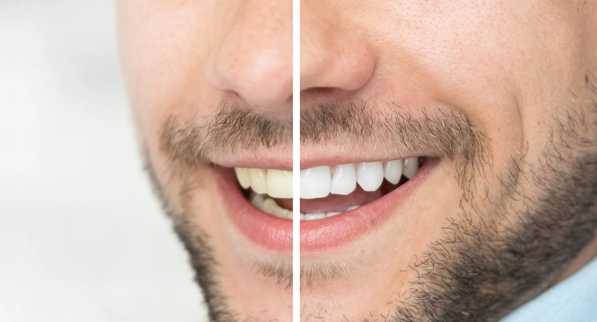 27423 home teeth whitening vs dentist overview