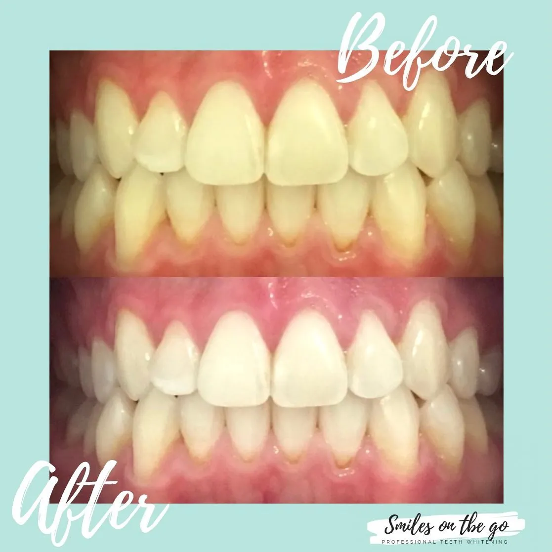 27440 teeth whitening aftercare