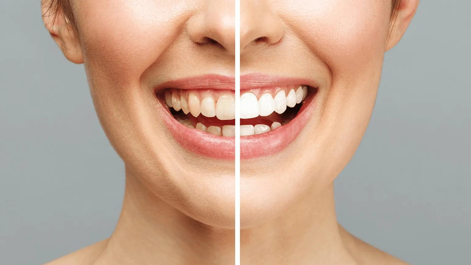 27452 teeth whitening strips