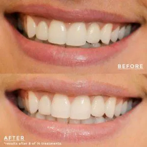 27463 baking soda whitening