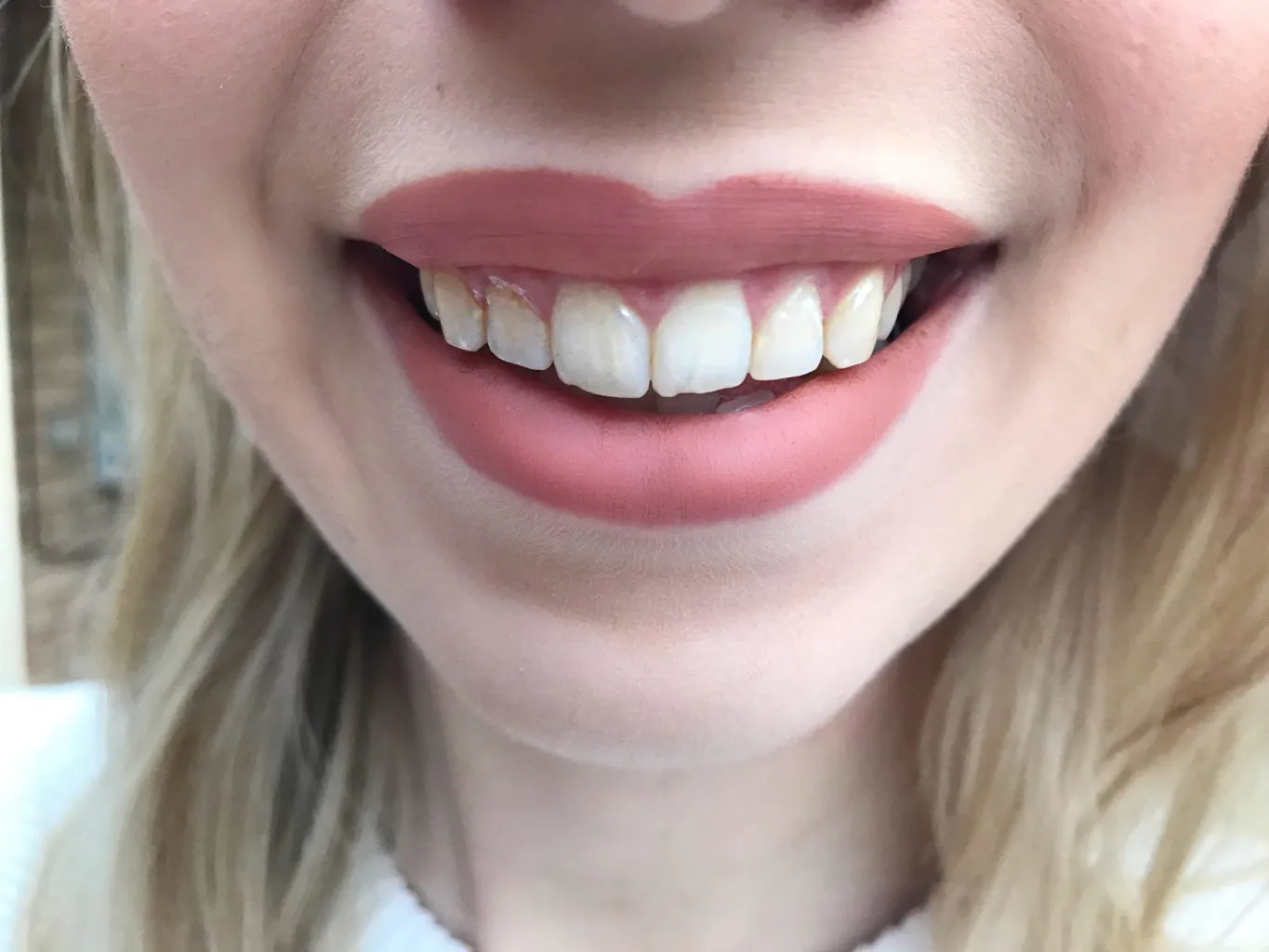 27464 teeth sensitivity