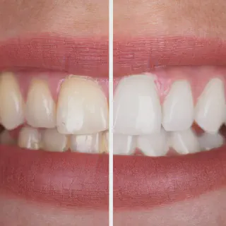 /img/27477-teeth-whitening-process-at-dentist.webp