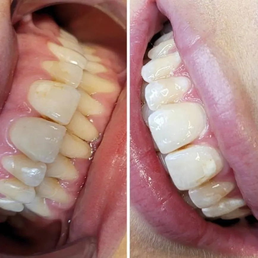 27497 gentle brushing