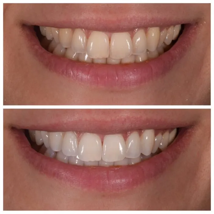 27519 zoom whitening cost factors