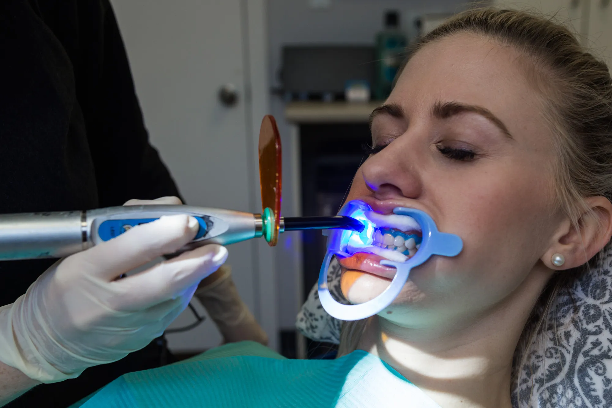 27520 teeth whitening basics