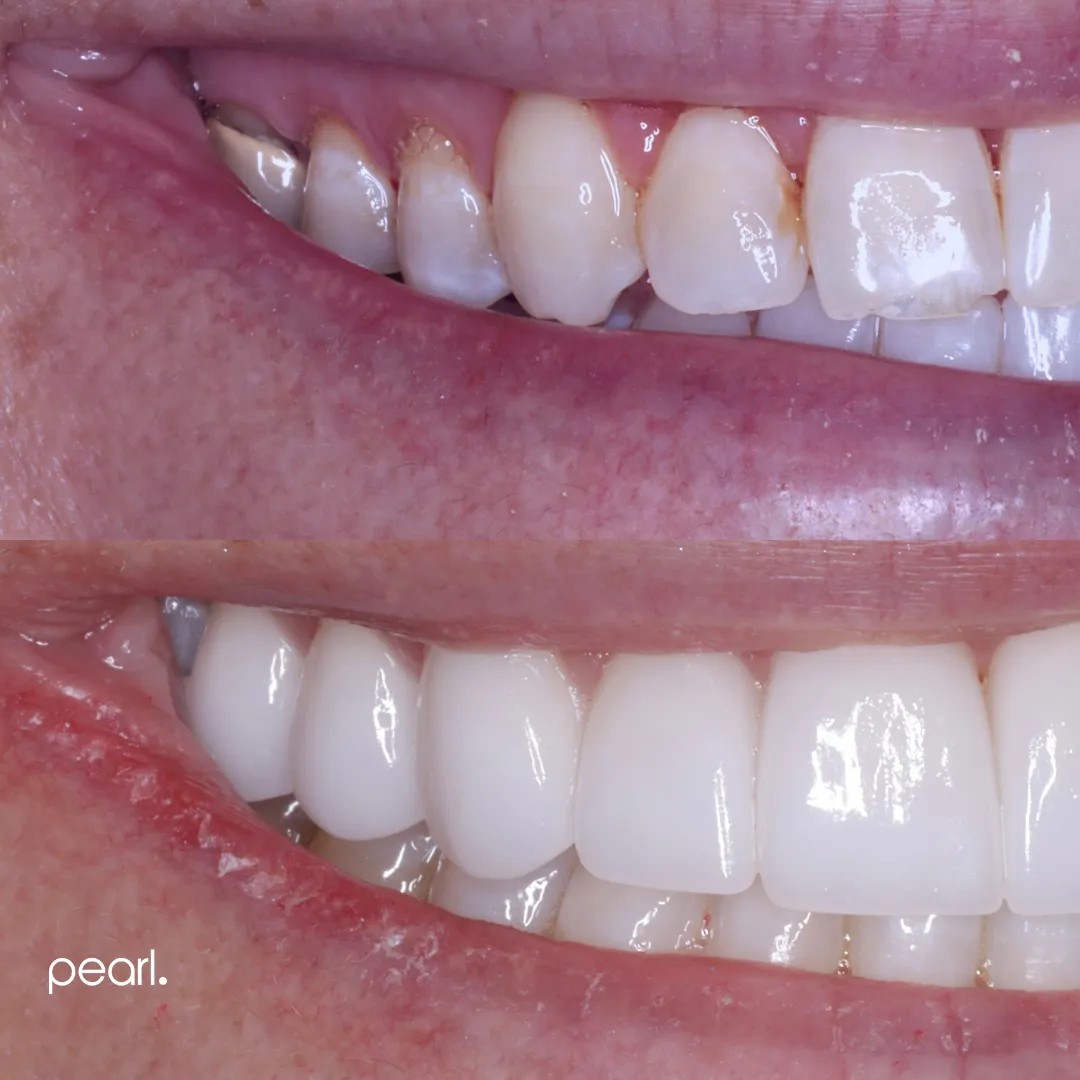 27520 teeth whitening methods