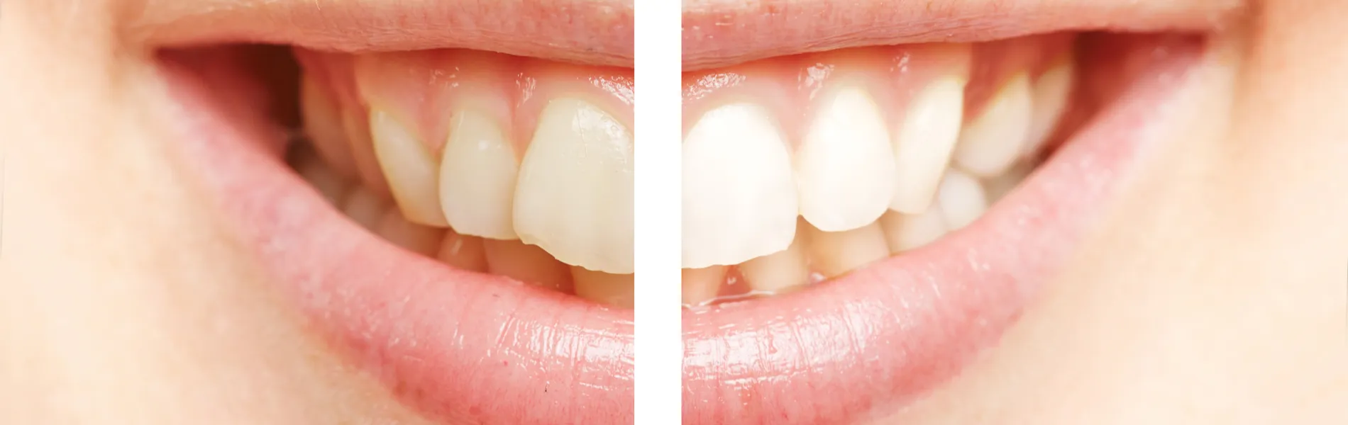 27524 teeth whitening candidate