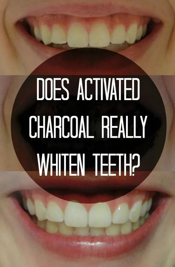 27536 charcoal teeth whitening before after