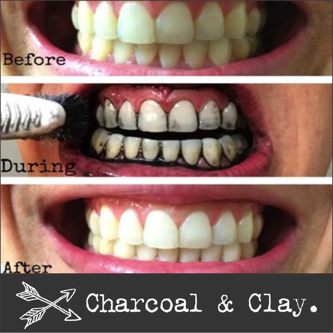 27536 teeth whitening alternatives