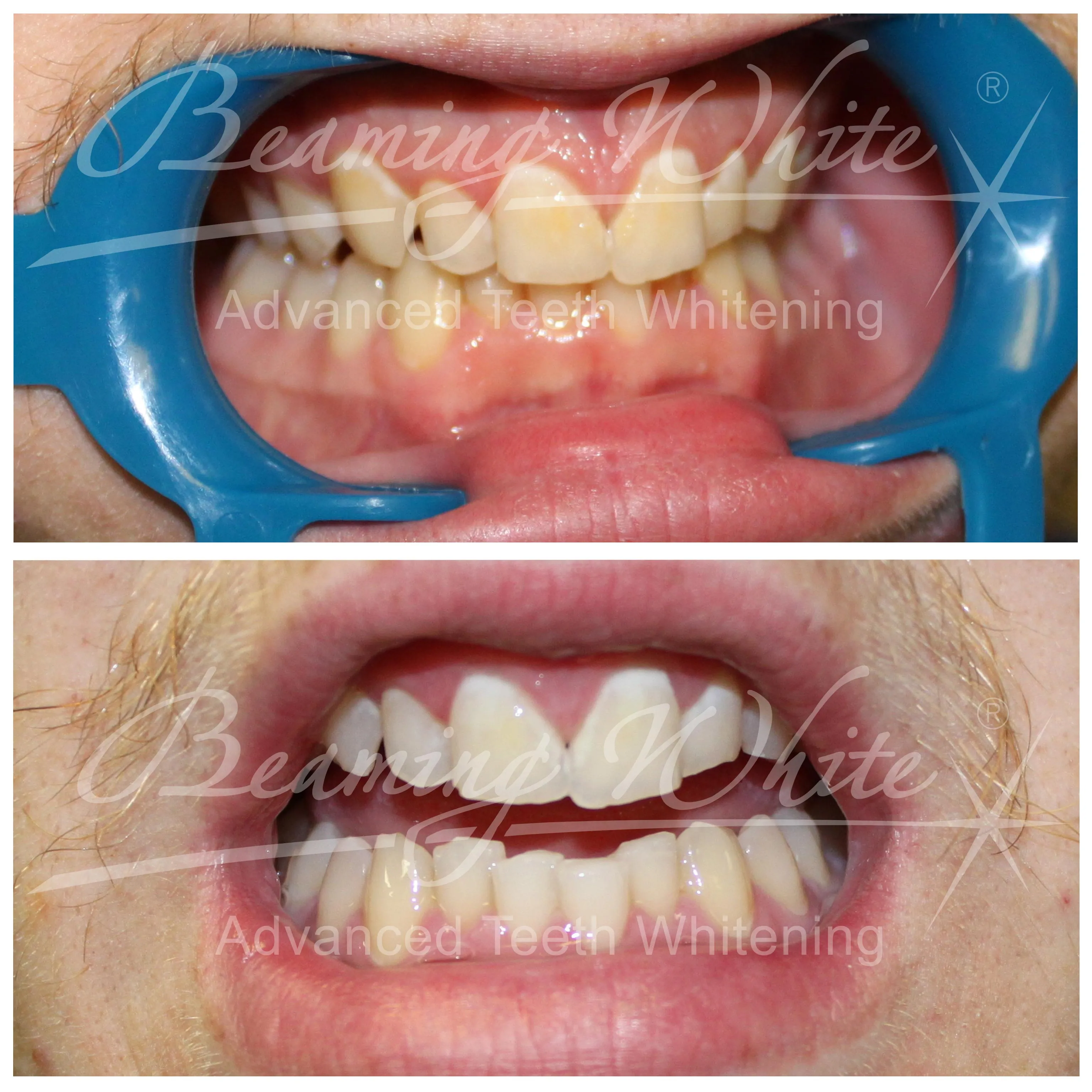27542 teeth whitening mistakes 1